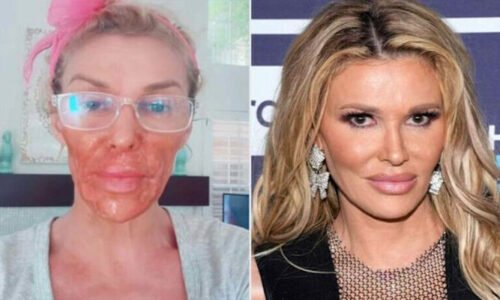 حسن بڑھانے کی کوشش میں بیوٹی ہیک مہنگا پڑ گیا، ماڈل کا چہرہ جھلس گیا