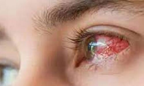 کراچی میں آشوبِ چشم کی وبا، اسپتالوں میں روزانہ درجنوں مریض رپورٹ